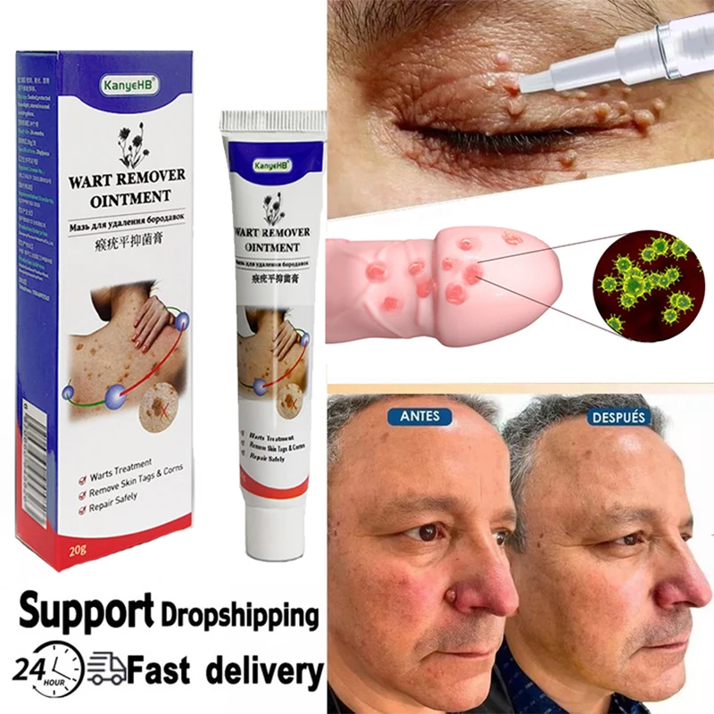 

Warts Remover Antibacterial Ointment Wart Treatment Cream Skin Tag Remover Genital Herpes Papillomas Treatment Ointment