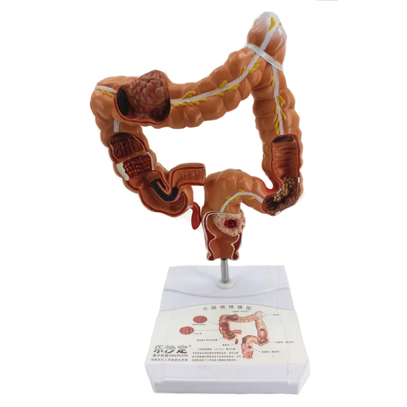 

Colon Pathology Model Large Intestine Model Colorectal Lesion Model Intestinal Disease Human Colon Lesion Model