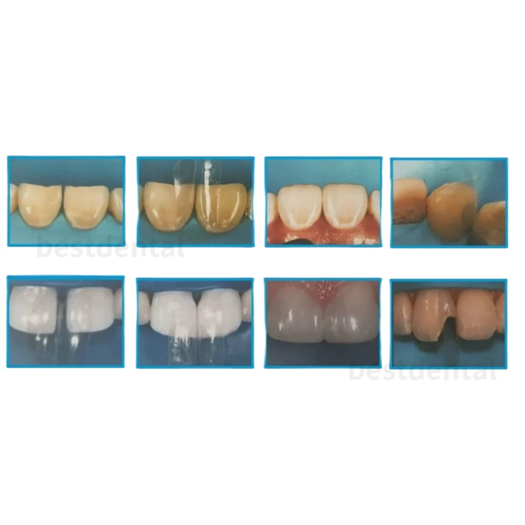 Стоматологические матрицы разных размеров диастема подходит для биопрозрачного
