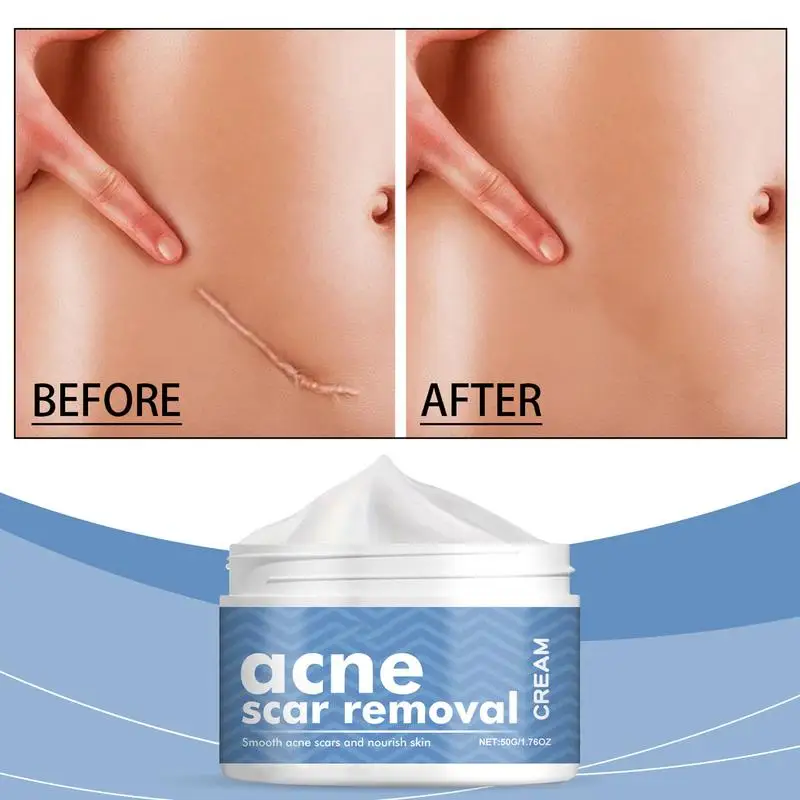 Крем для лица удаления прыщей гель против лечение шрамов от сужение пор