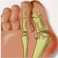 2pair gel big toe separator hallux valgus bunion corrector orthotics thumb bone feet massage pedicure sock straightener spreader