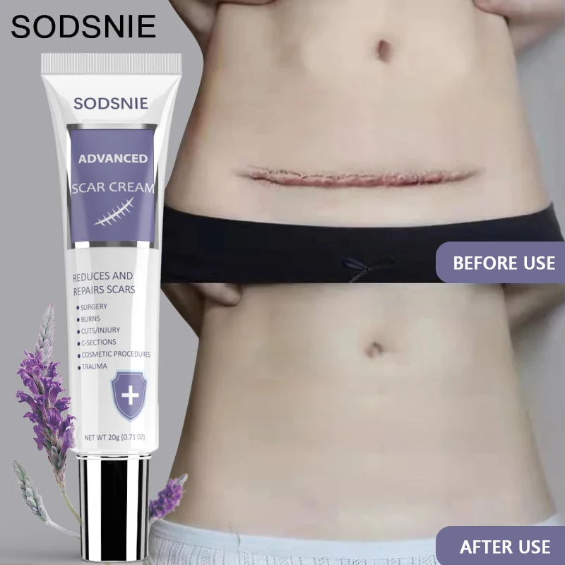 

Advanced Scar Cream Skin Repair Scars Treatment Smooth Whitening Effective Remove Burn Stretch Marks Acne Spots Body Care 20g