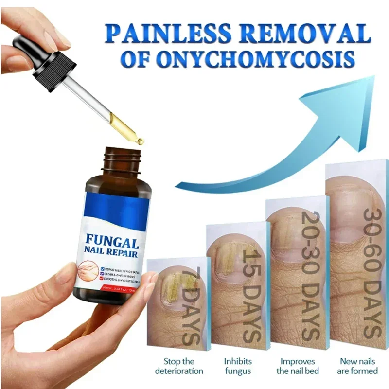 Сыворотка для лечения грибка ногтей средства восстановления пальцев ног гель