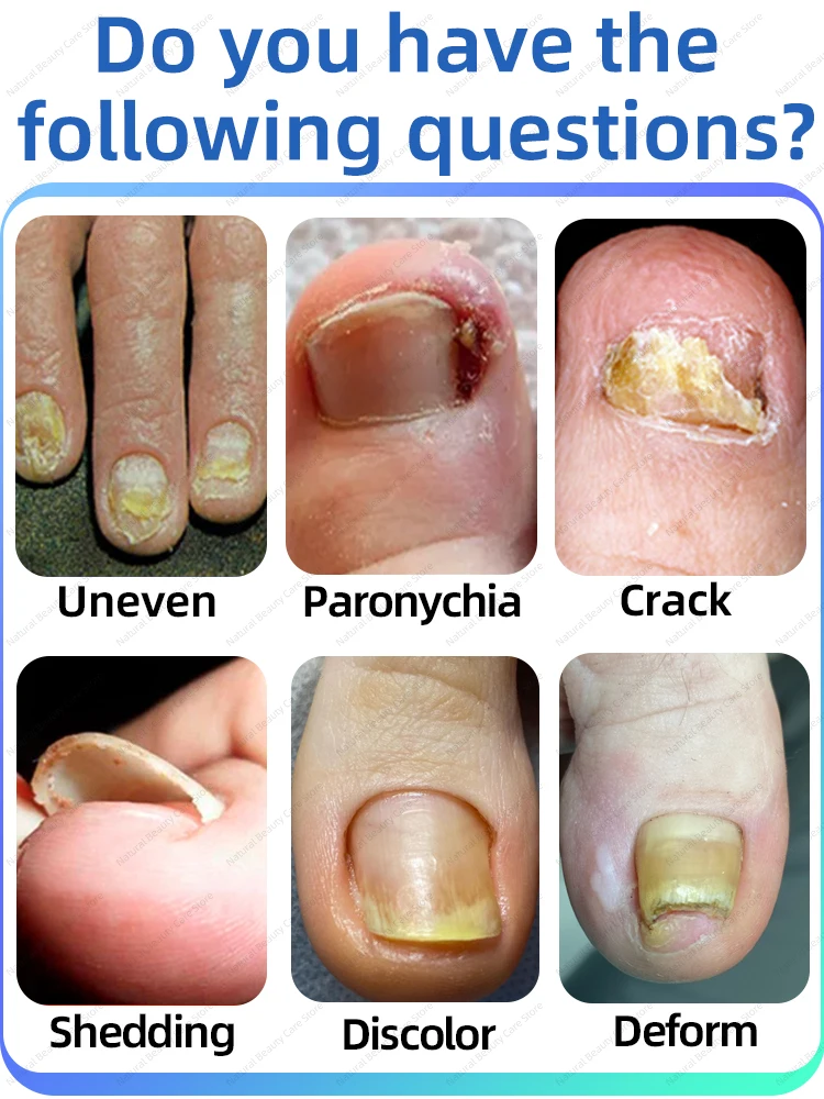 Рисунок 3 - Грибковый ноготь