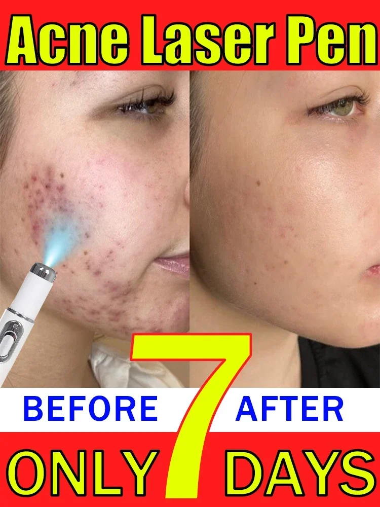 Acne laser pointer serum creams for the face