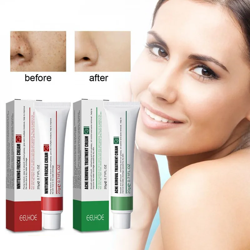 

Acne Anti-spot Cream Lightens Spots Brightens Even Skin Tone Moisturizes Skin Acne Pigmentation Skin Care Repair Cream Beauty