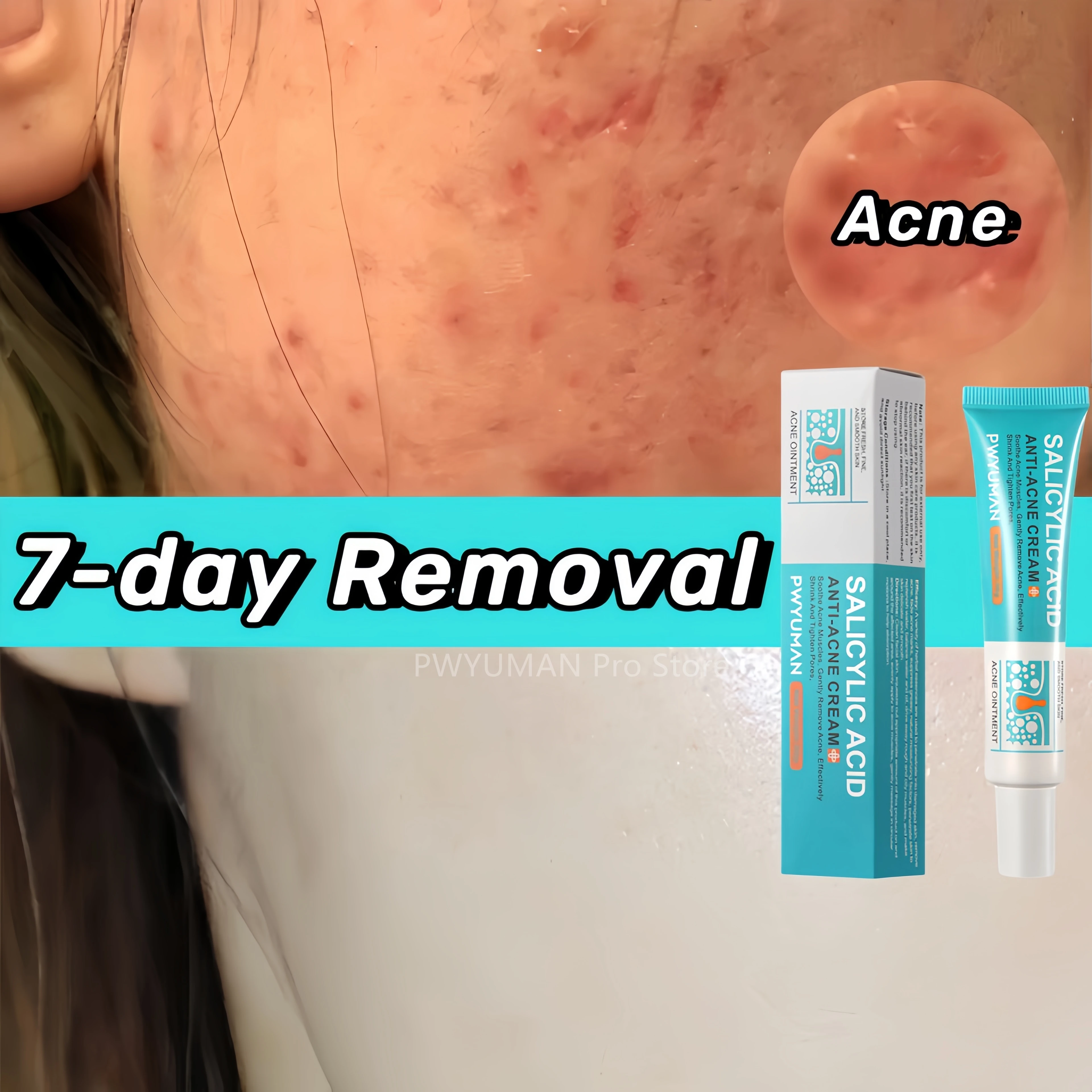 

Fast Acne Remove Cream Salicylic Acid Oil Control Repair Treatment Closed Acne Fade Acne Marks Blackhead Pore Shrink Skin Care