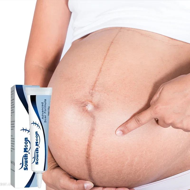 Хирургический крем для удаления шрамов и акне зерна растяжек отбеливания геля