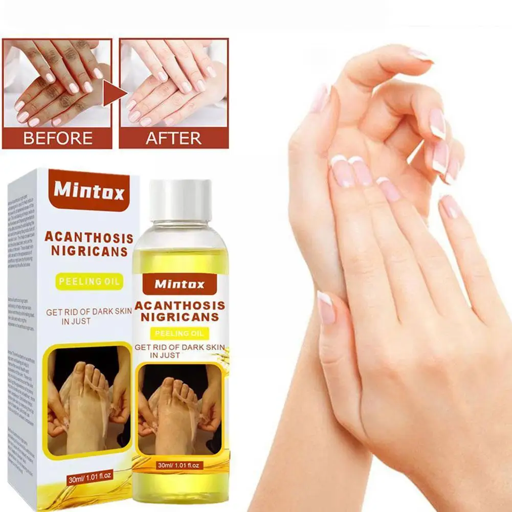 

Bleaching Peeling Oil Brightening Dark Skin Removes MelaninAcanthosis Dead Oil Peeling Arm Exfoliating Legs Nigricans Elbow V1Q2