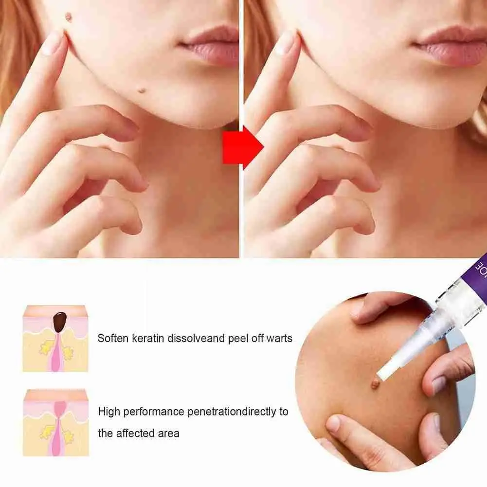 

Warts Flat Warts Skin Repair No Trace Beauty Of Papilloma Treatment Warts Removal Pen Mole Care Liquid X1l2