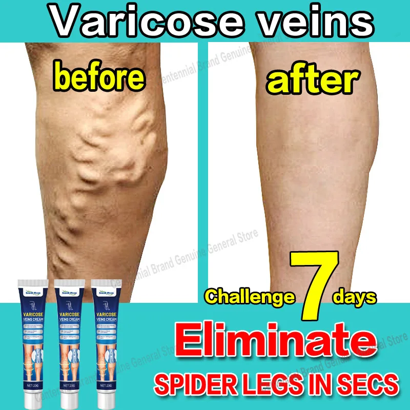 

Лечение Варикозного расширения вен эффективное облегчение варикозного расширения вен, облегчение при васкулите флебит паутина лечение бо...