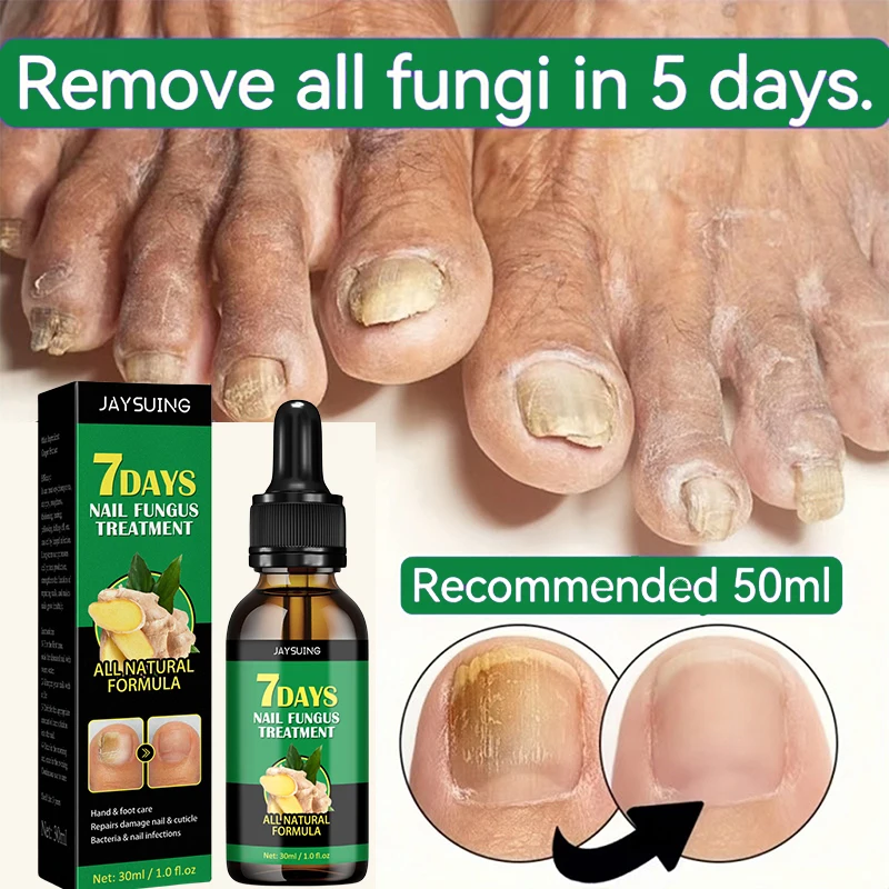 

Эссенция для релаксации ногтей, сыворотка для удаления грибка на ногах и ногах, Перманентный восстанавливающий гель против инфекции онихомикоси