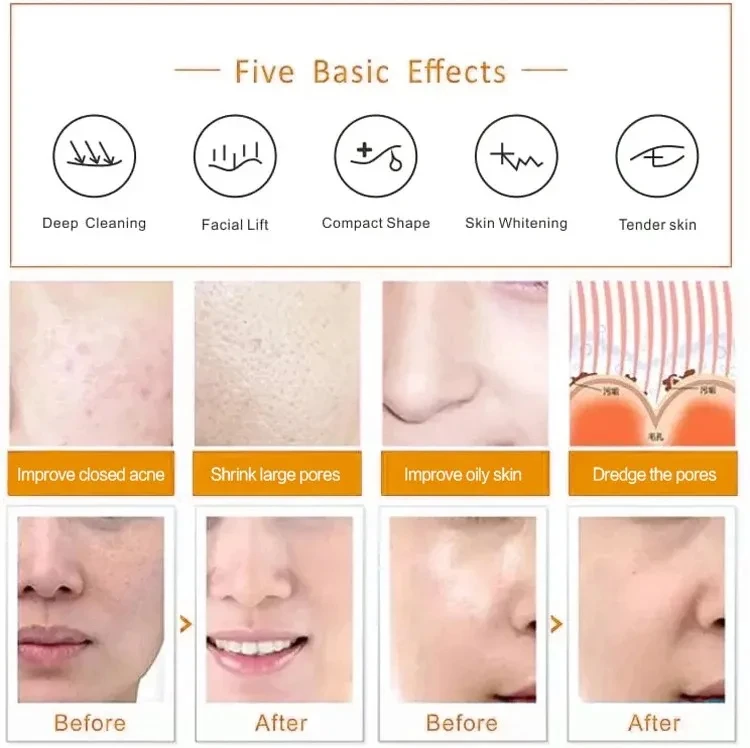 4 в 1 Aqua Jet Peel спа-кислородная инфузия H2O2 скруббер для кожи AquaSure крошечная