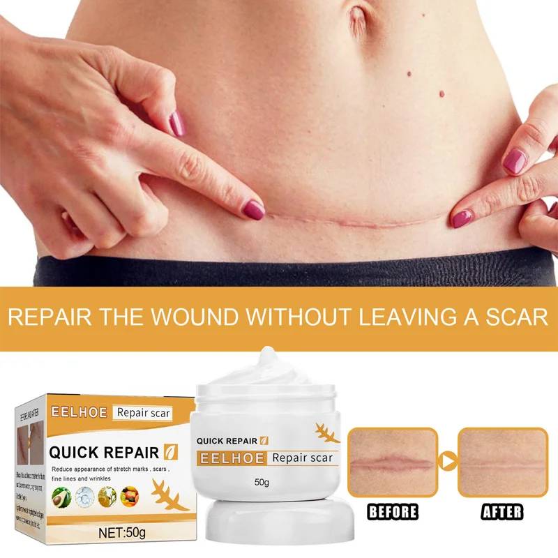 

Scar Acne Removal Face Cream Gel Stretch Marks Acne Spots Burn Surgical Scars Treatment Smooth Whitening Body Beauty Skin Care