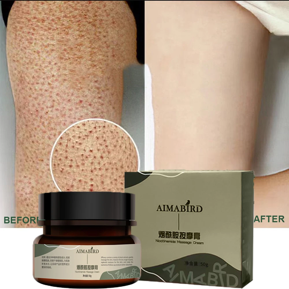 

Repair Chicken Skin Cream Treatment Keratosis Follicle Dead Skin Remove Thick Pore Whitening Brightening Smoothing Body Care 50g