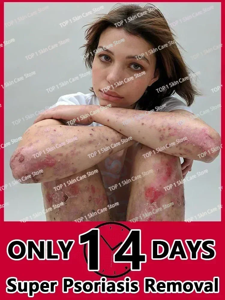 Натуральный растительный экстракт для удаления псориаза от дерматита