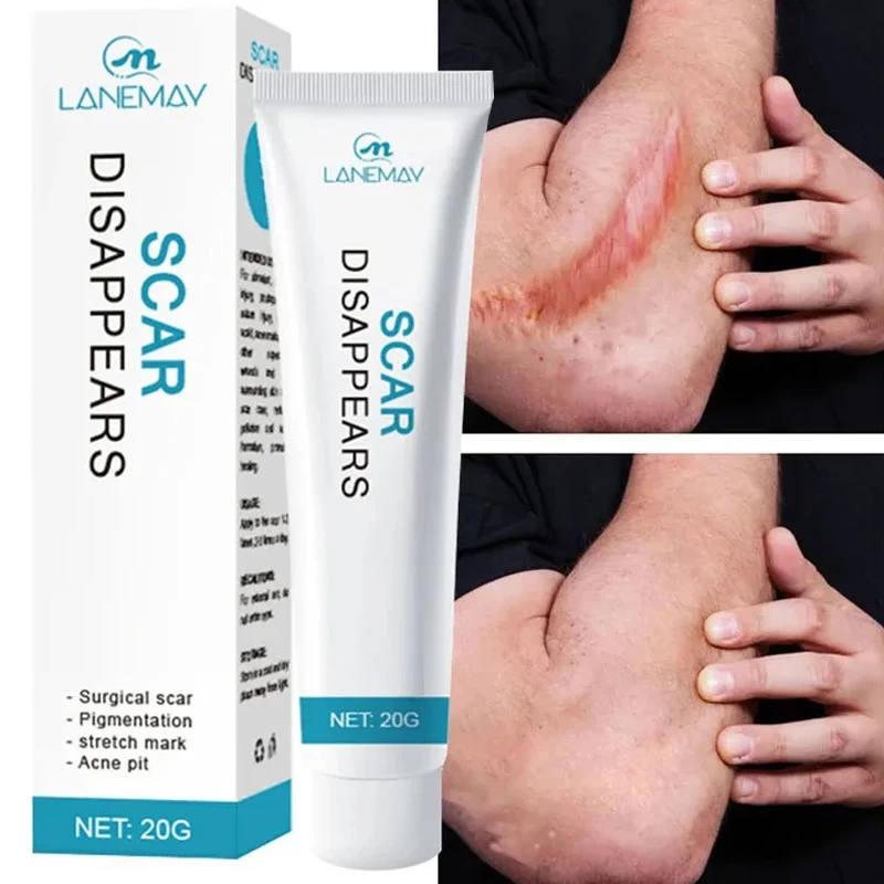 

Scar Removal Cream Repair Stretch Marks Burn Surgical Acne Scars Herbal Treatment Pigmentation Whitening Moisturizing Skin Care