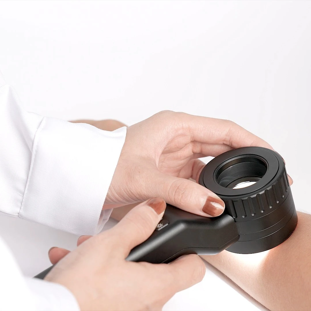 

IBOOLO DE-4100 Advance Professional Achromatic HQ 10x Magnifier Medical Dermatoscopio Dermatoscope for Moles