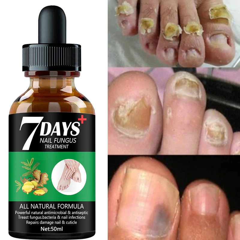 

7DAYS Fungal Nail Treatment Serum Foot Repair Essence Care Whitening Toe Nail Fungus Removal Gel Anti Infection 50ml