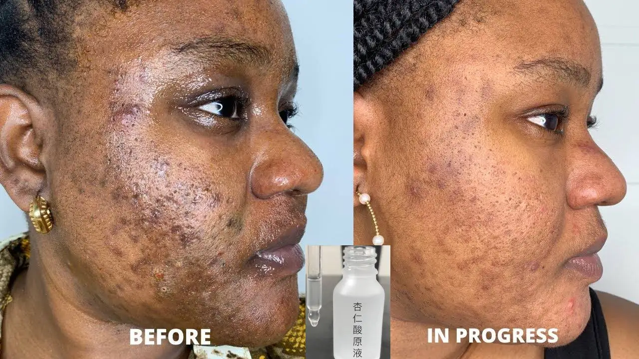 

Mandelic Acid 20 AHA Alpha Hydroxy Peel For Rosacea Cystic Acne, Blackheads Pores Whiteheads Hyperpigmentation Melasma Age Spots