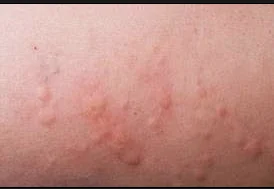 

METRIN 5% Permethrin Cream 30g/1oz Treatment Scabies And Pubic Lice Itch Relief