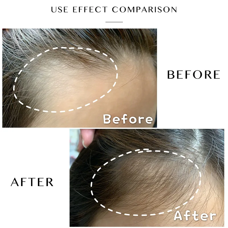 

air Growth Oil Growth Essence Anti Hair Loss Treatmen Dense Hair Fast Hair Natural Ginger Grow Restoration Growing Serum