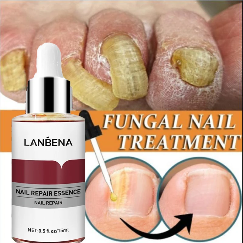 

Сыворотка LANBENA для восстановления ногтей, эссенция против грибка, удаление ногтей, гель против инфекции, осветление рук, ног, уход за ногами