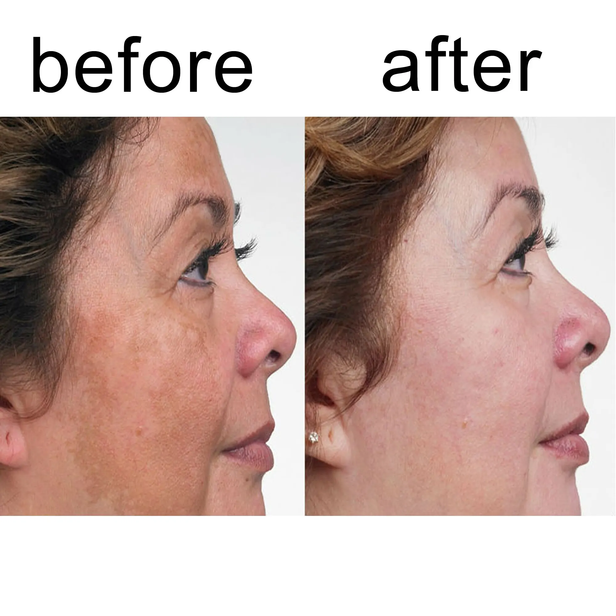 

Expigment 30g 1oz Hydroquinone Cream 2% For Skin Bleaching Skin Lightening Whitening Skin Melasma Anti-blemish