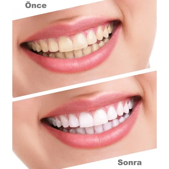 Ultradent Opalescence Pf 15 Home Type Teeth Whitening 2'li Syringe-Smile… |