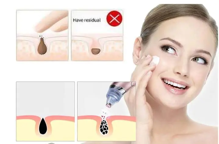 WONDERFULL AMAZİNG Vacuum Blackhead Remover Face Cleaner Rechargeable Beautiful Skin FREE SHİPPİNG