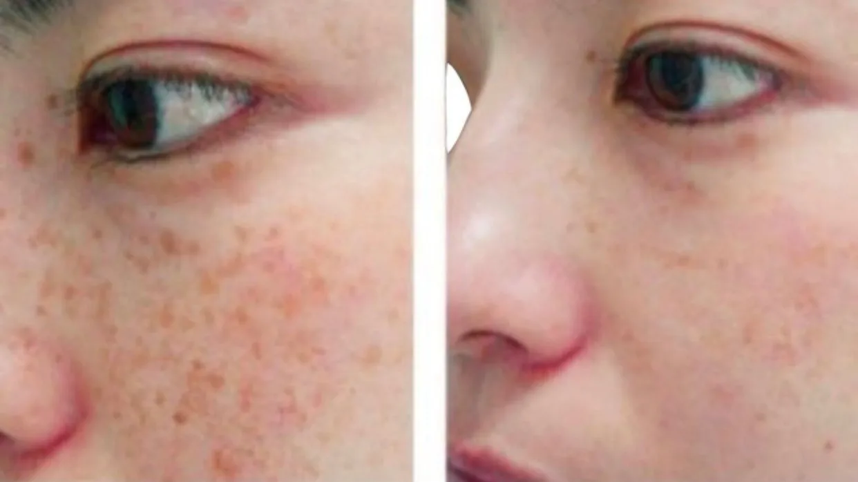 

EXPIGMENT HYDROCONE FACE AND SKIN CREAM 4% BLACK SPOT REMOVAL CREAM WHITENING SKIN ACNE RED FACE CARE