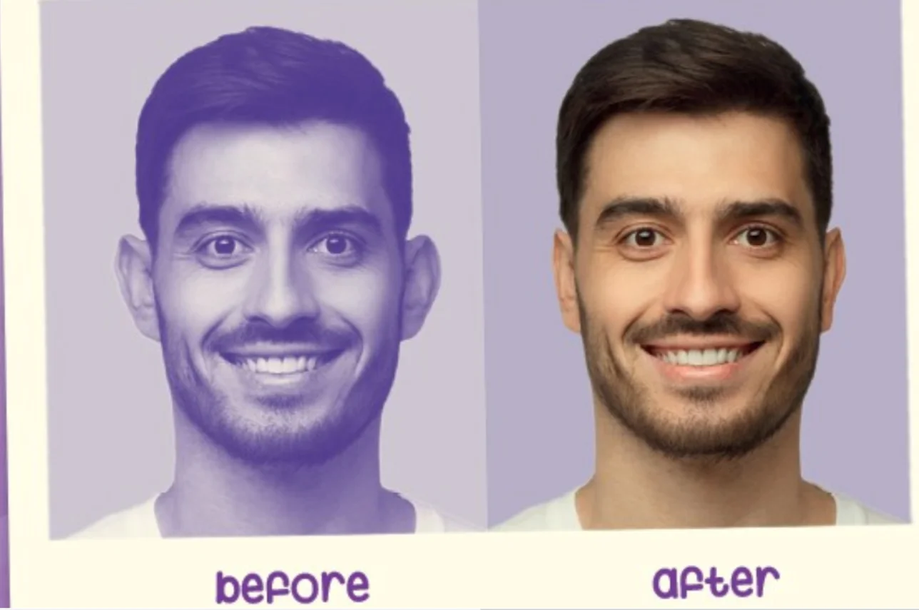 protruding or prominent ear aesthetic corrector concealer adhesive tapes easy and effective use harmless to skin cleaner new product free global sh