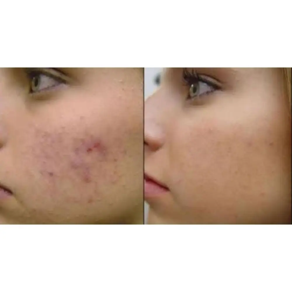 Экстракт гидрохинона для лица и кожи лечение акне мелкие морщины отбеливание