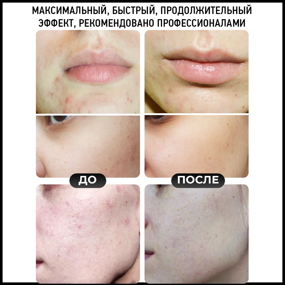 Салициловая кислота 10 процентная. Салициловая кислота люминесценция. Салициловая кислота 10 процентная. Лучшие кислоты от прыщей. Салициловая кислота 4%.