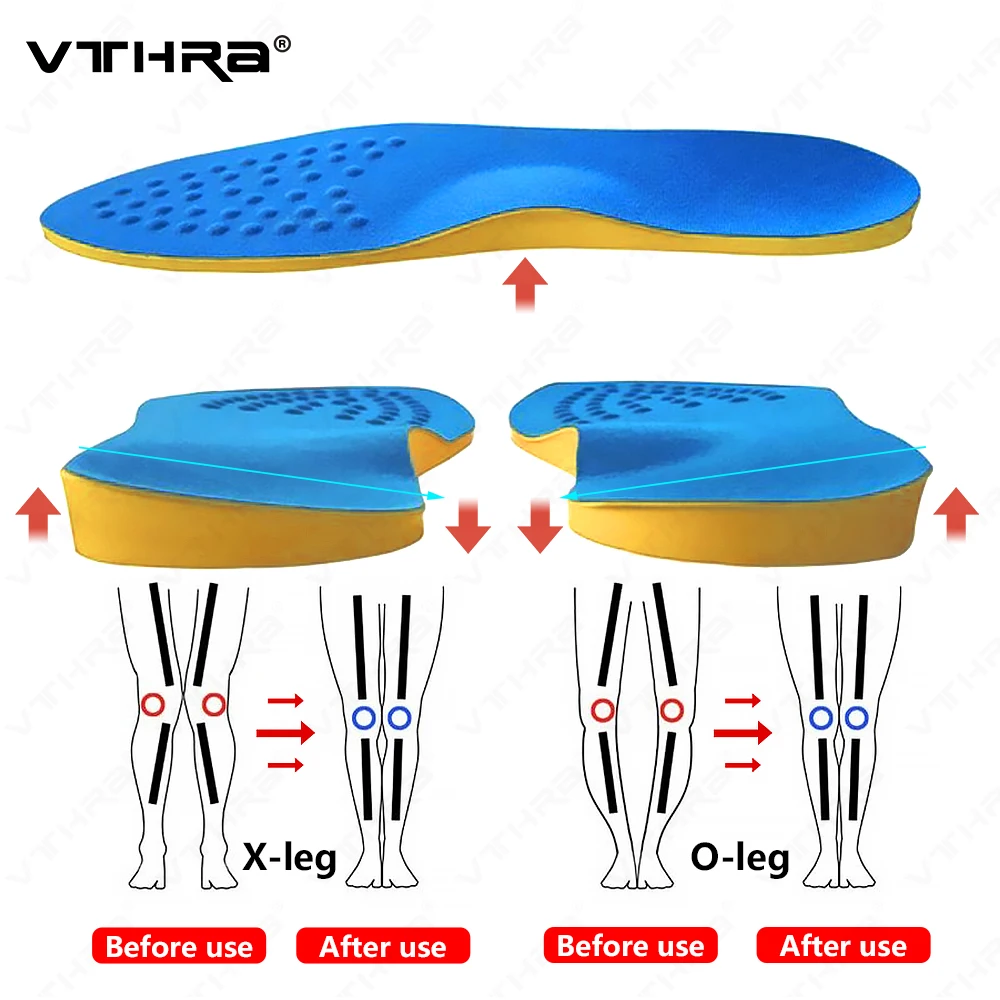 

Orthopedic Insoles For Feet Corrective O Type Leg Insoles Inserts For Foot Alignment Knock Knee Pain Bow Legs Valgus Varus Pad