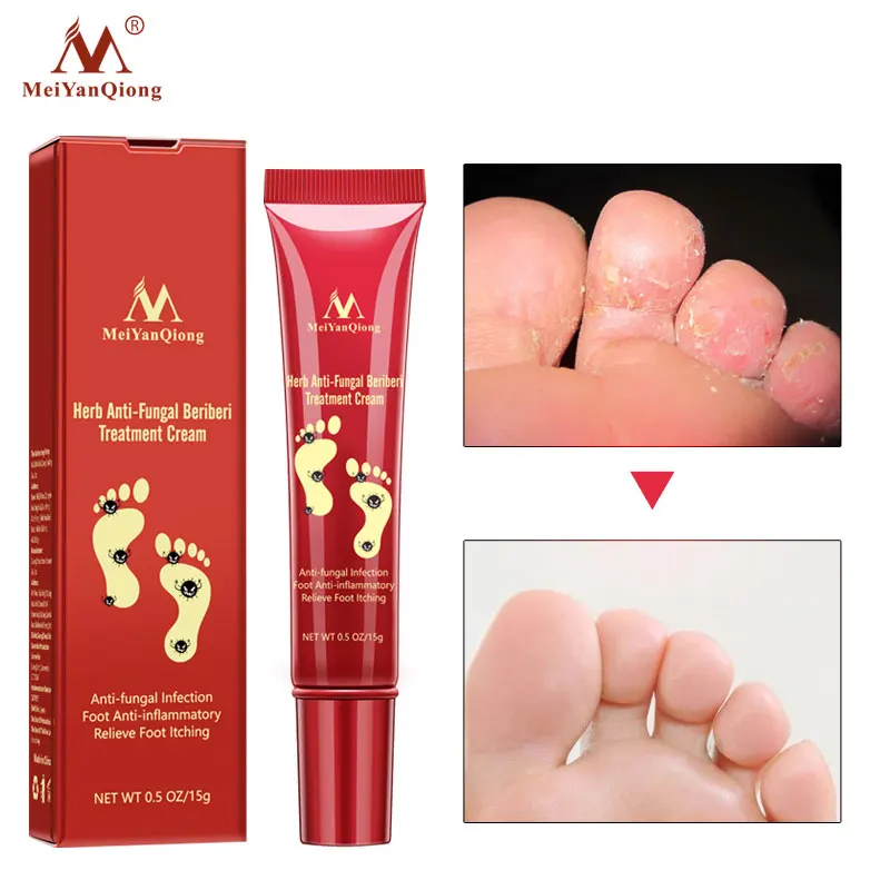 

Herbal Effective Foot Treatment Anti Fungal Infection Onychomycosis Paronychia Toe Fungus Treatment Feet Repair Cream Foot Care