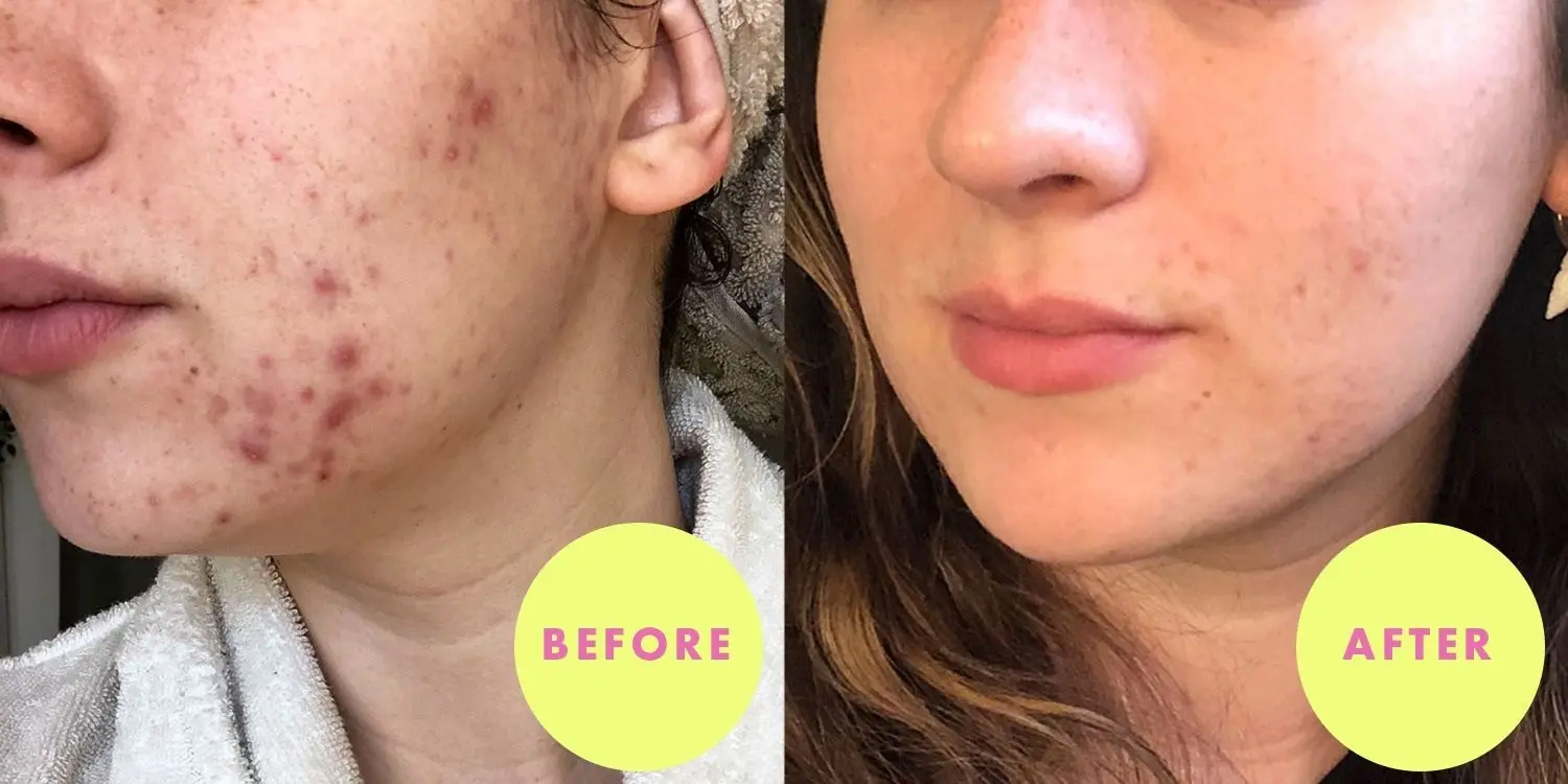 

BACTROBAN Mupirocin 2% Pomade 15 g inflamed acne swelling hair root inflammation stitched wounds cracks erythema