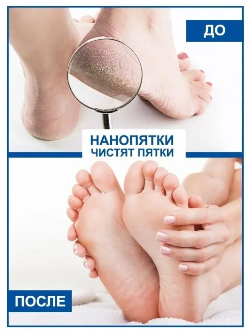 НАНОПЯТКИ Средство для педикюра 500 мл + пемза |