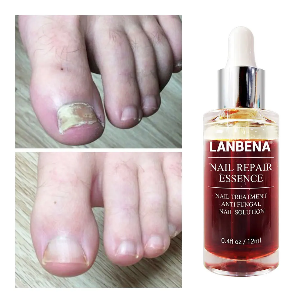 Лечение грибка для ногтей LANBENA с пилкой против гриба удаление онихомикоза Уход за