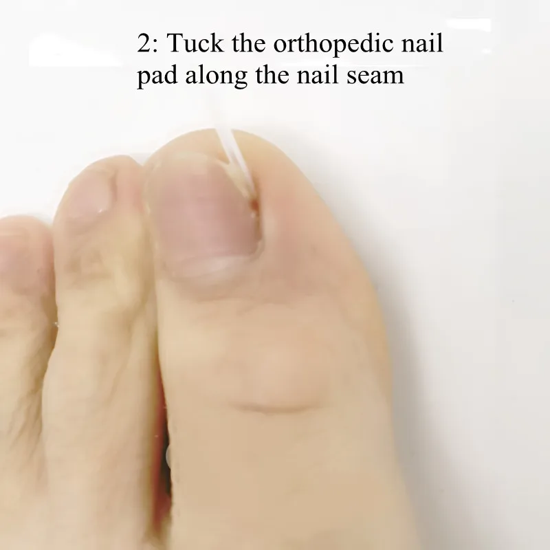 

Nail Ingrown Onychomycosis Padding Pads Orthodontic Stickers Nails Toe Nails Toe Nails Nail Clippers Package наклейки на ногти