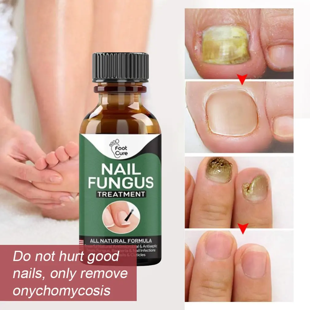 

Nail Repair Solution Repair And Nourish The Nail Remove Onychomycosis Gentle And Comfortable Repair Solution