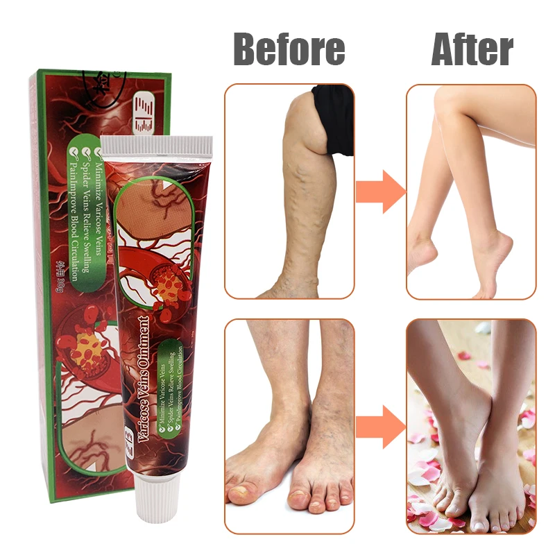 Травяная мазь для лечения флебита паука крем облегчения боли в венах улучшения