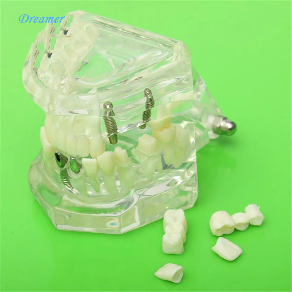 Модель зубного импланта с восстановлением и мостовыми зубами, идеально подходит для планирования лечения и обсуждения с пациентами от AliExpress WW