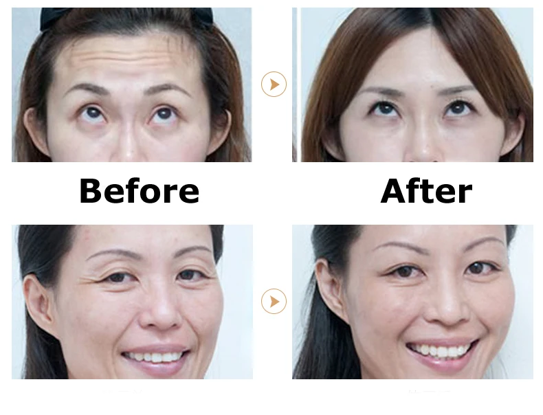 Без Иглы гидропотока гиалурон ручка мезо микроиглы терапевтическая система