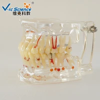 dental model full mouth teeth pathology model with half implant