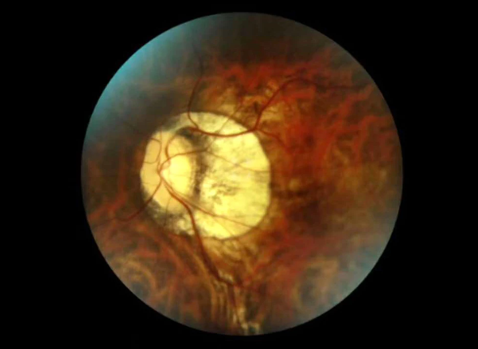 Портативная портативная немидрическая Скрытая камера с бесплатной доставкой FDA |