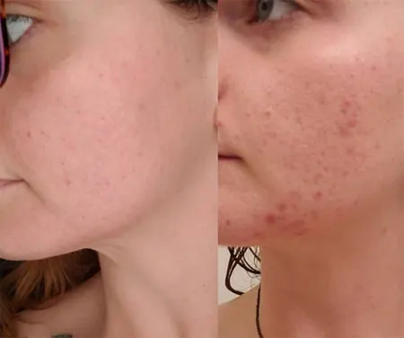 Gel Original Differin 0.1%, tratamiento para el acn&eacute;, 30g / 1oz, retinoide gran fuerza, perfecto-4