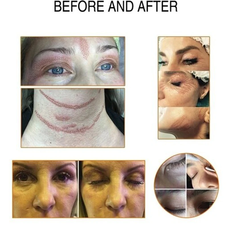 Плазменная ручка Maglev с 3 иглами прибор для подтяжки век лифтинга кожи удаления