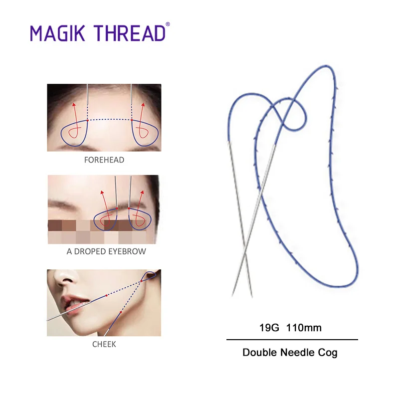 Косметическая хирургия для подтяжки кожи молдинг ПДО рыбья кость лица и тела с