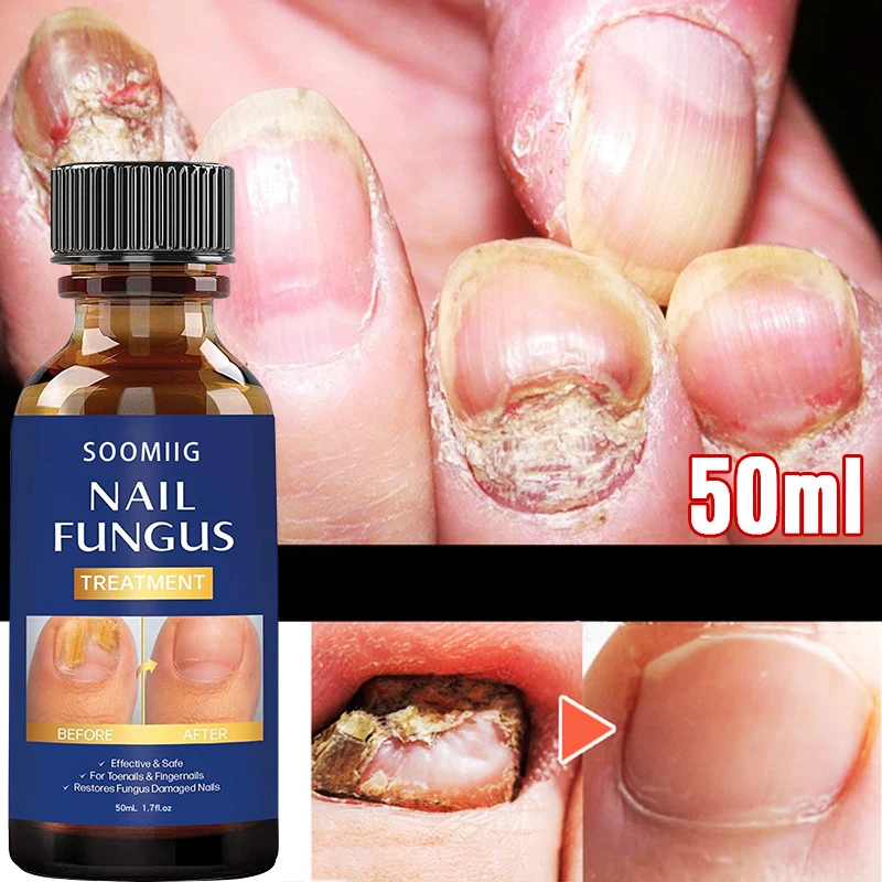 

Nail Fungus Treatment Feet Care Essence Nails Foot Repair Toe Nail Fungal Removal Gel Anti Infection Paronychia Onychomycosis